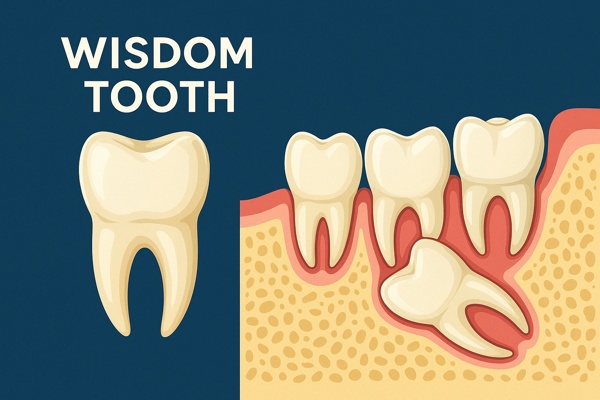 Зуб мудрости: особенности строения, прорезывания и удаления